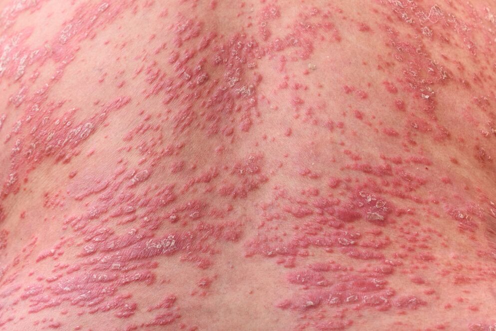 What does psoriasis look like